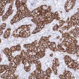 Genetex Breast Cancer 1