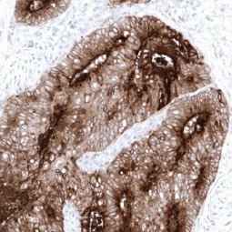 Genetex Colorectal Adenocarcinoma 1