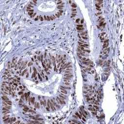 Genetex Colorectal Adenocarcinoma 2