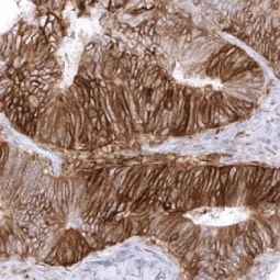 Genetex Colorectal Adenocarcinoma 3