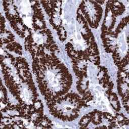 Genetex Colorectal Adenocarcinoma 4