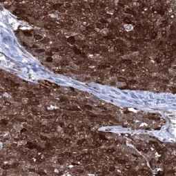 Genetex Esophageal Squamous Cell Carcinoma 1