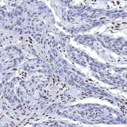 Genetex Esophageal Squamous Cell Carcinoma 3