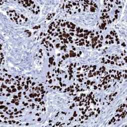 Genetex Esophageal Squamous Cell Carcinoma 5