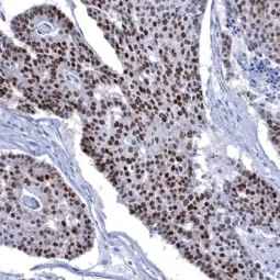 Genetex Esophageal Squamous Cell Carcinoma 6