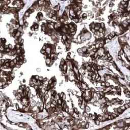 Genetex Lung Cancer 1