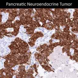 Genetex Neuroendocrine Tumors 1