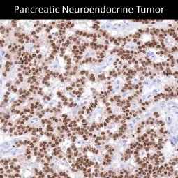Genetex Neuroendocrine Tumors 2