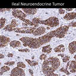 Genetex Neuroendocrine Tumors 3