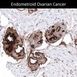 Genetex Ovarian Cancer 2