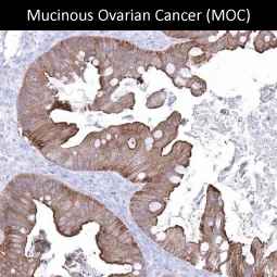 Genetex Ovarian Cancer 3