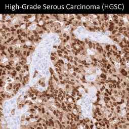 Genetex Ovarian Cancer 5