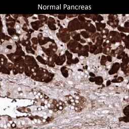Genetex Pancreatic Cancer 1