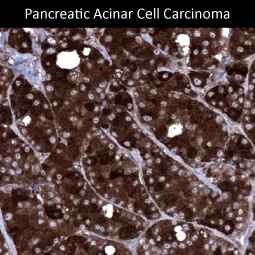 Genetex Pancreatic Cancer 2
