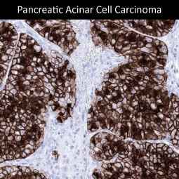 Genetex Pancreatic Cancer 3