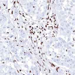 Genetex Pancreatic Cancer 4
