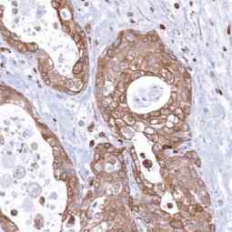 Genetex Pancreatic Cancer 5