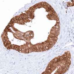 Genetex Pancreatic Cancer 6