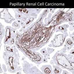Genetex Renal Cell Carcinoma 2