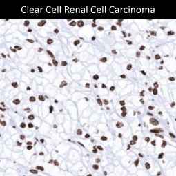 Genetex Renal Cell Carcinoma 3