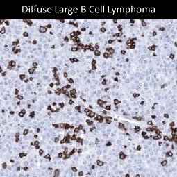 Genetex iffuse Large B Cell Lymphoma 1