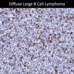 Genetex iffuse Large B Cell Lymphoma 2