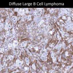 Genetex iffuse Large B Cell Lymphoma 3