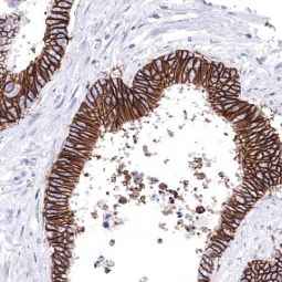 Gnetex Colorectal Adenocarcinoma 5